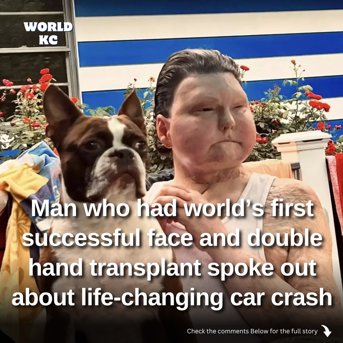 Man who had world’s first successful face and double hand transplant spoke out about life-changing car crash